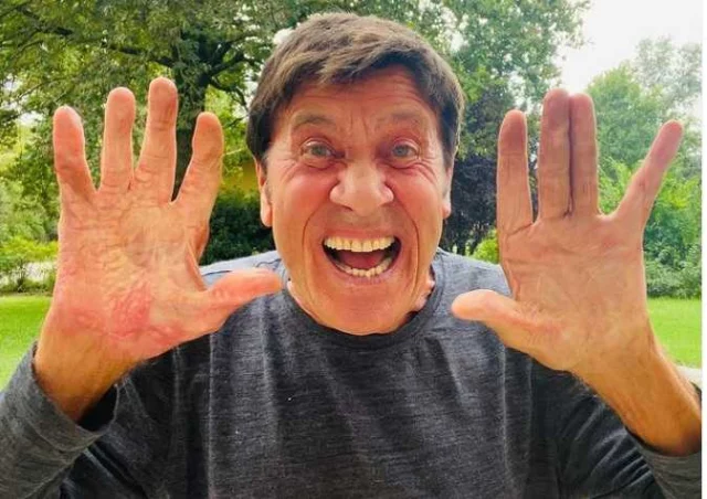 La mano bruciata di Gianni Morandi