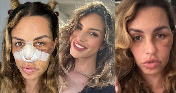 Temptation Island Carlotta Adacher col volto lesionato dopo l