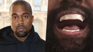 Kanye West si è fatto rimuovere i denti per un impianto in titanio