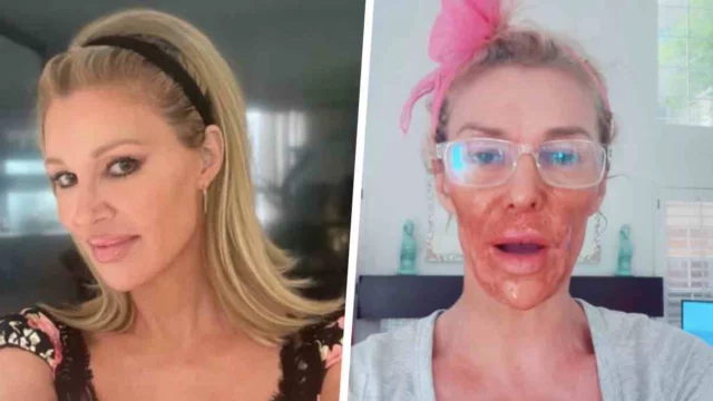 Brandi Glanville applica la crema depilatoria sul volto, è sfigurata