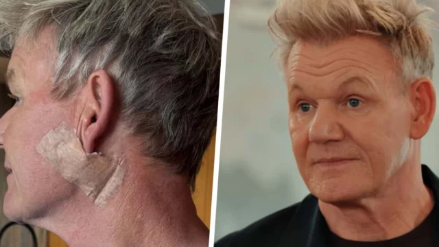 Gordon Ramsay operato tumore pelle