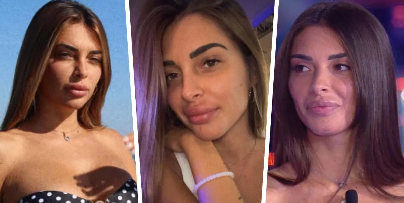L’ex del GF Greta Rossetti rimuove il filler alle labbra e rivela i motivi di questa scelta