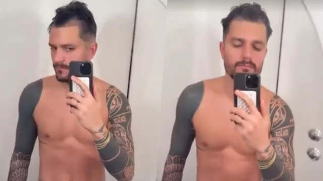 Andrea Zelletta si sottopone al trapianto di capelli, il racconto