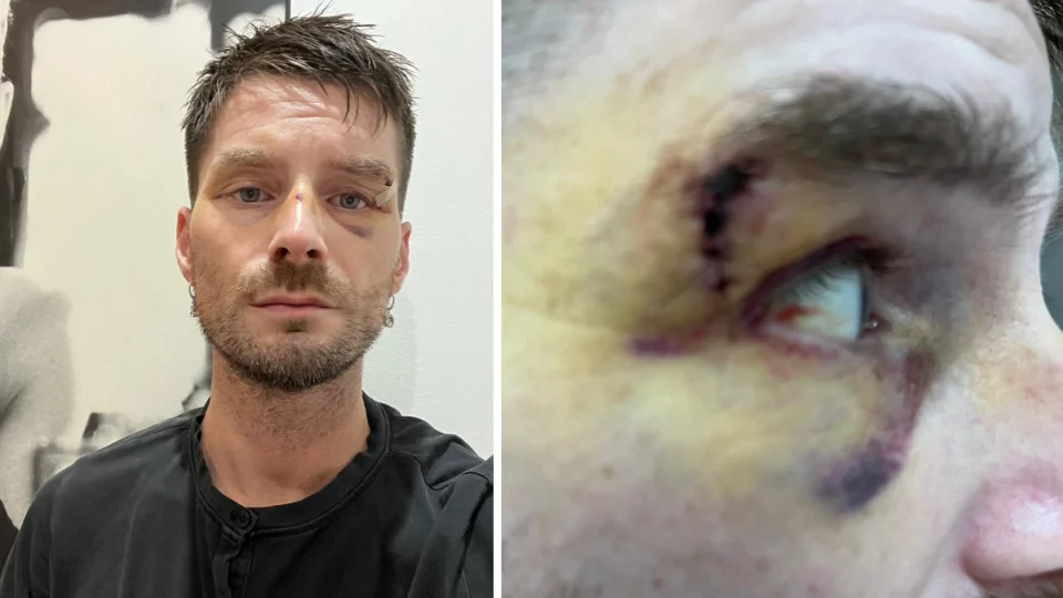Leggi sulla sicurezza: Luca Burini dopo l'aggressione subita a Milano